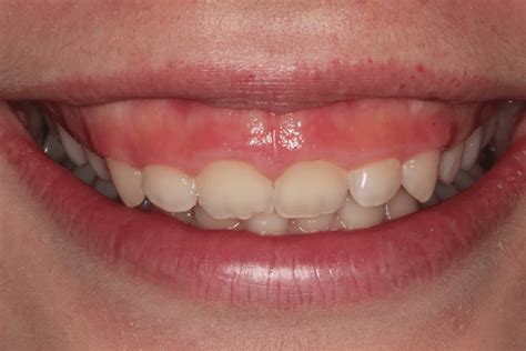 small teeth big gums treatment